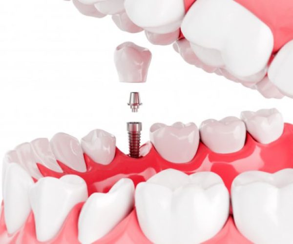 Implantat je odličen nadomestek manjkajočih zob